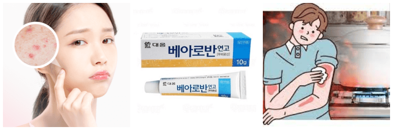 여드름, 베아로빈 연고, 화상 사진