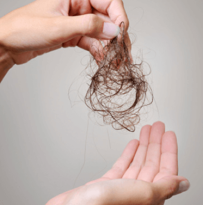 탈모에 대한 기준