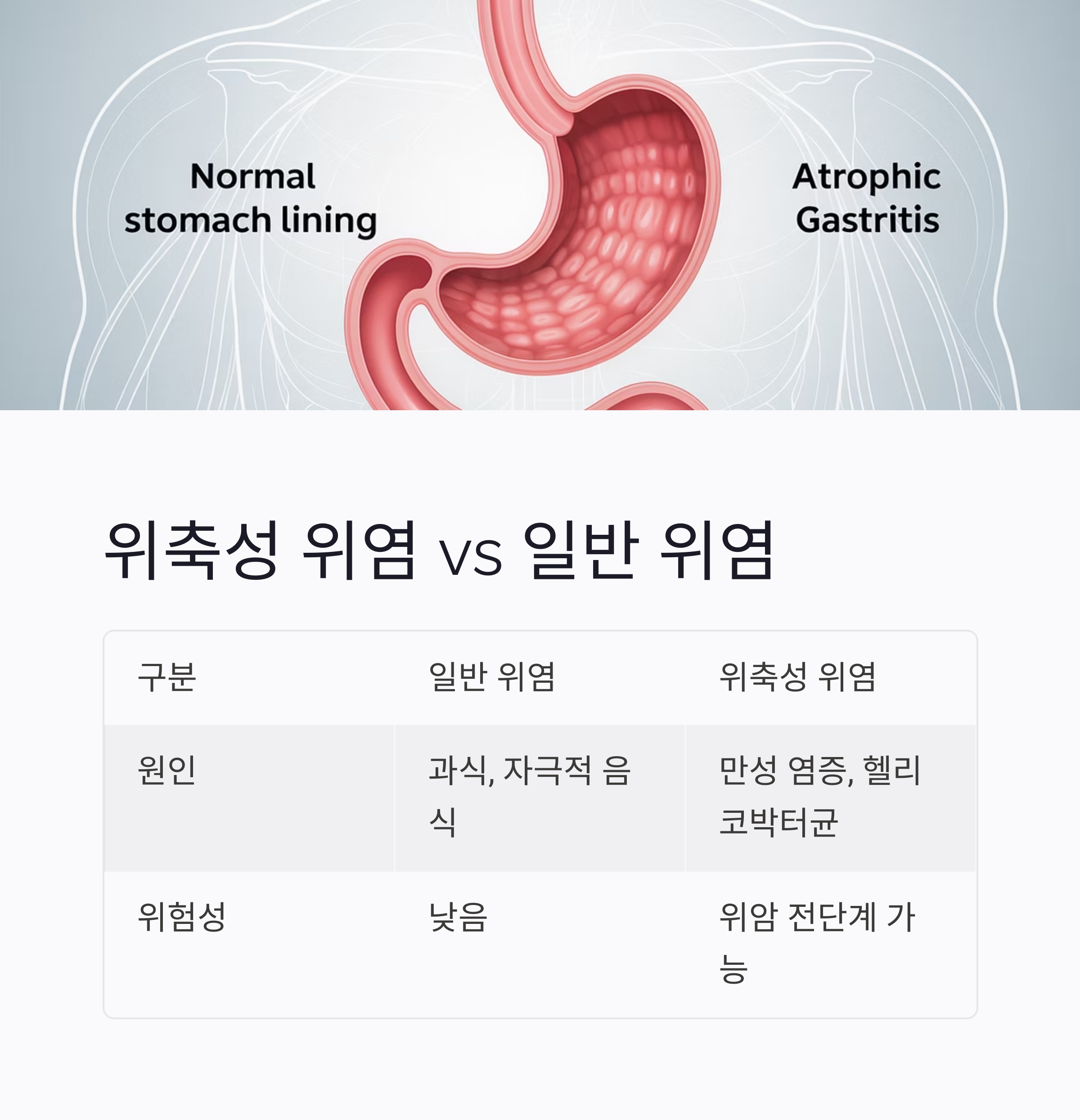 위축성위염-일반위염