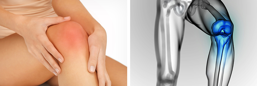 퇴행성 관절염 증상