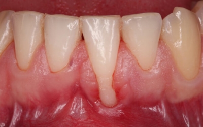 잇몸이 붓고 아플때
