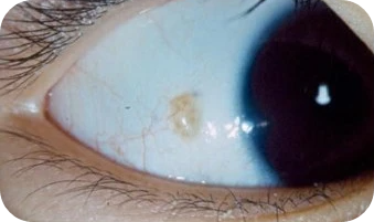 눈동자 점 결막모반 눈알 흰자 갈색 검은색 회색 주요 특징 치료 필요 방법 비용 실비 건강 보험 적용