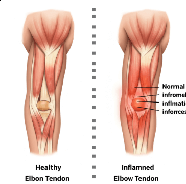 골프 엘보 증상과 관리법3