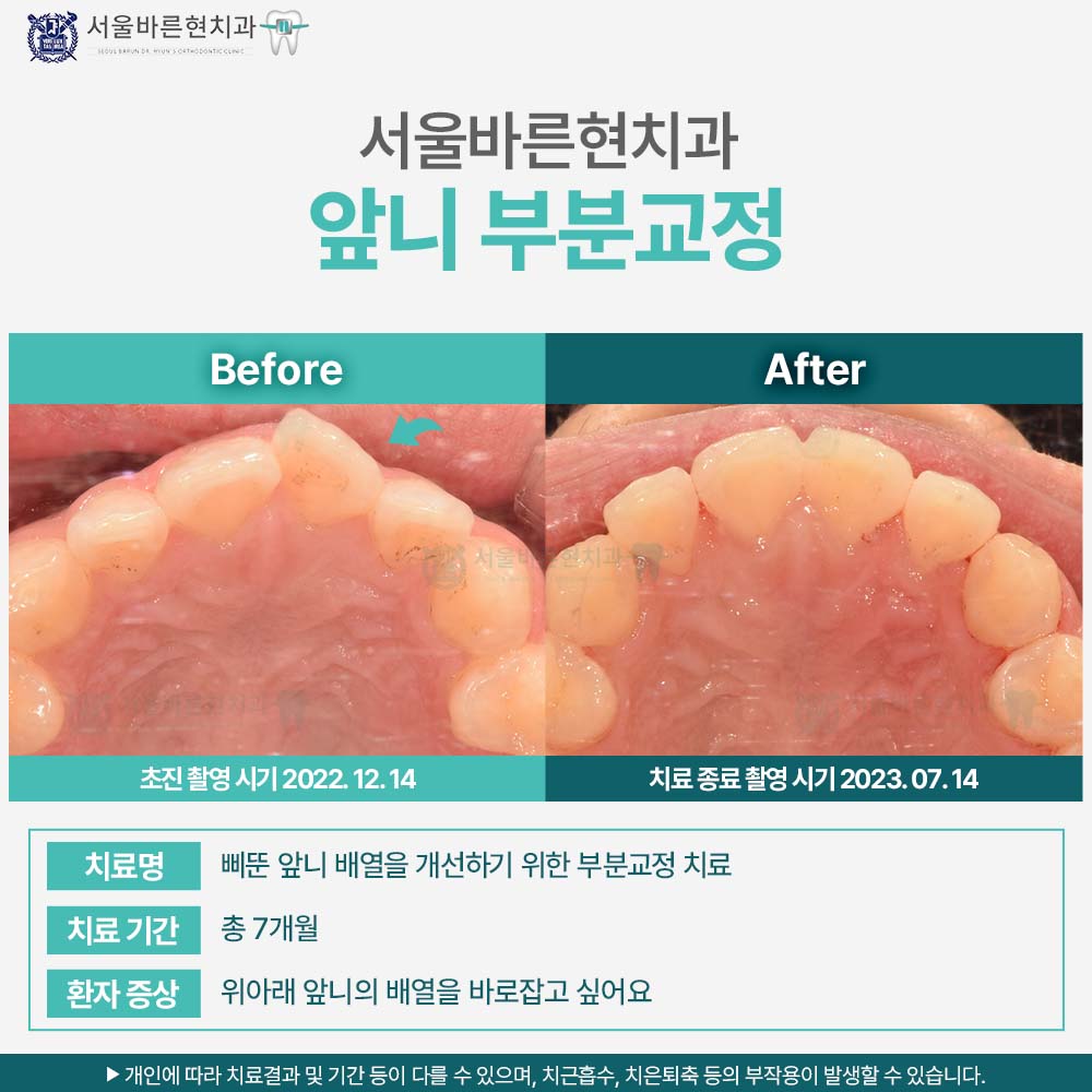 해운대치아교정