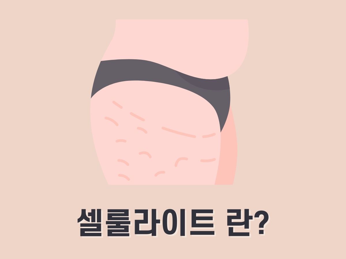 셀룰라이트란