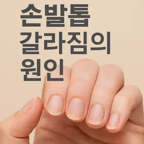 손톱이 갈라진 손 사진 위에 "손발톱 갈라짐의 원인"이라는 제목이 적혀 있는 그림
