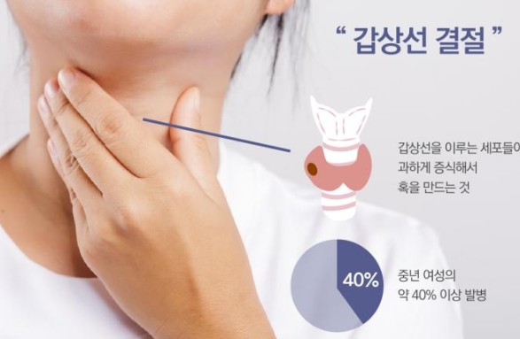 갑상선 중년 여성의 병
