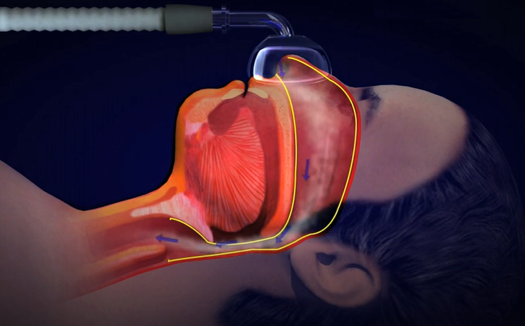 양압기 사용으로 인해 기도가 넓어지는 사진