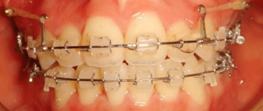 치아교정장치 세라믹