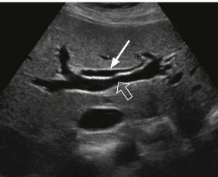intrahepatic duct measurement(right)