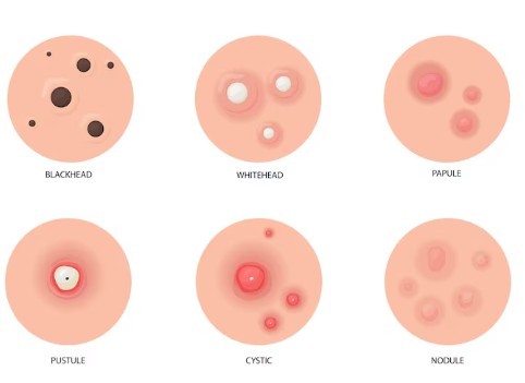 대상포진-전염-예방-수칙-전염성-3