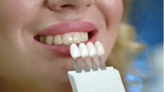 앞니 임플란트 수명