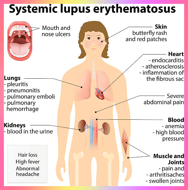 루푸스병 증상