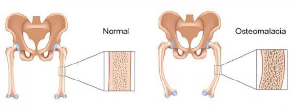 골다공증의 원인과 증상
