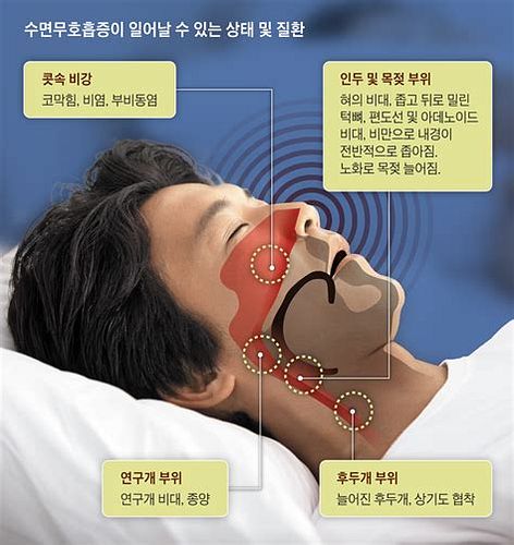 코골이 고치는 법