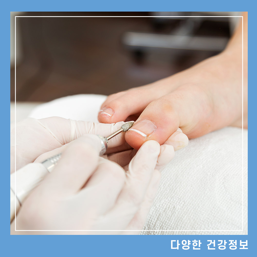 발톱무좀-없애는-방법