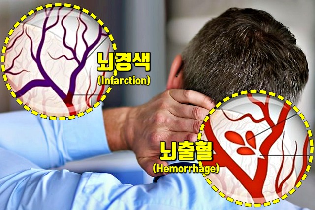 뇌졸중 전조 증상, 뇌경색 초기증상, 뇌졸중 초기증상, 건강 팁줌 매일꿀정보