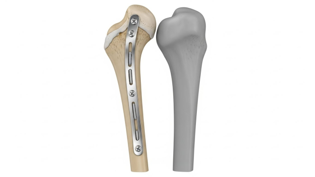 비골에 금속판과 나사가 고정된 수술 후 상태 개념도