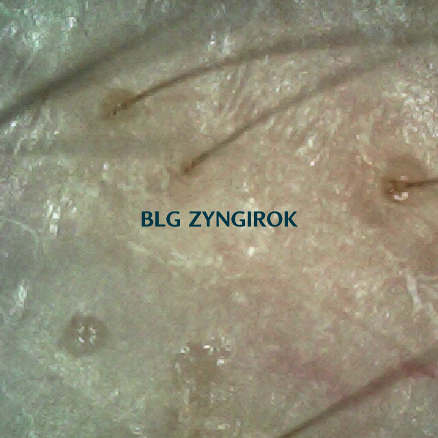 피나모아 복용 26주차 오른쪽 M자 부위 두피모습이다.