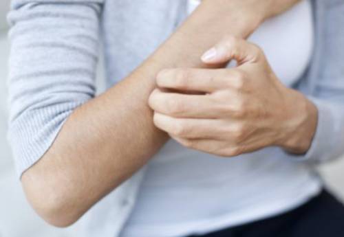 스트레스 두드러기