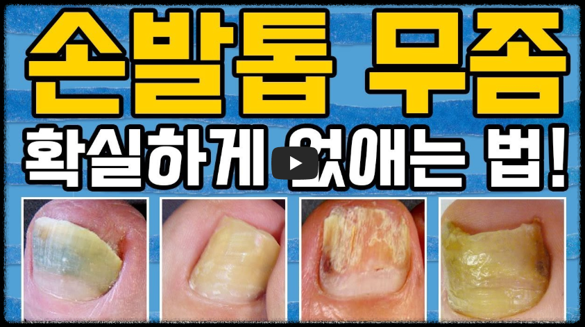 발톱무좀 원인과 제거하는 꿀팁 총정리 (2025ver)