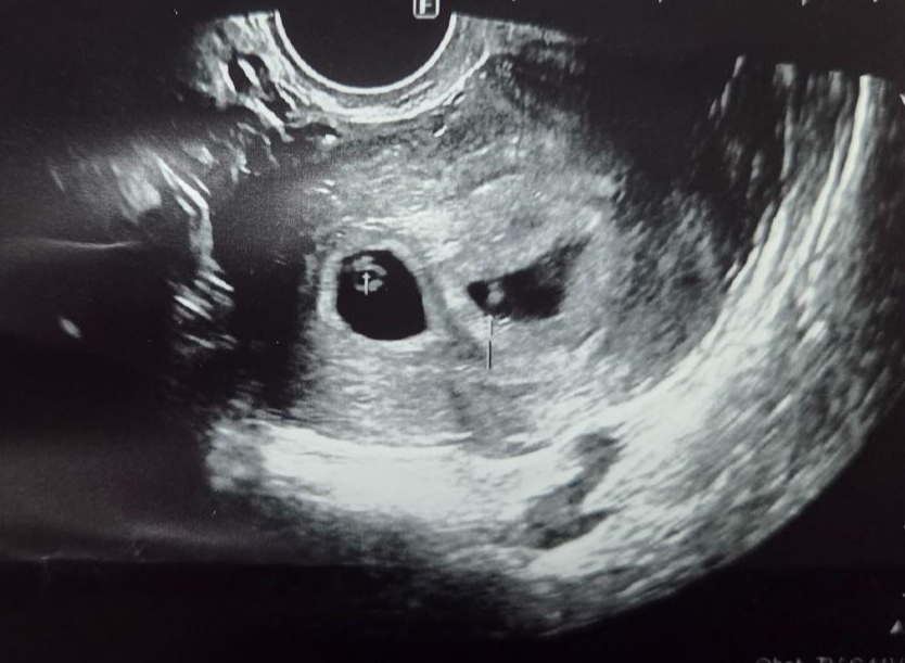 임신6주차초음파