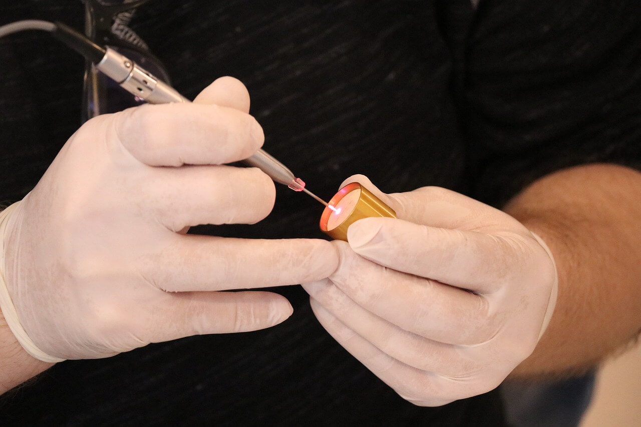 발바닥 티눈 제거 - 냉동&amp;#44; 레이저 치료