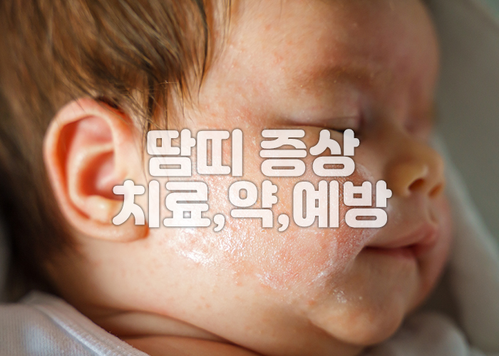 아기얼굴에 땀띠 약이 발려져 있다