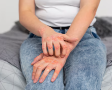 피부 붉은반점 28