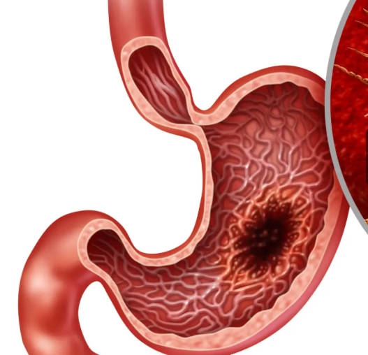 위암 걸렸을 때 위의 단면 모습