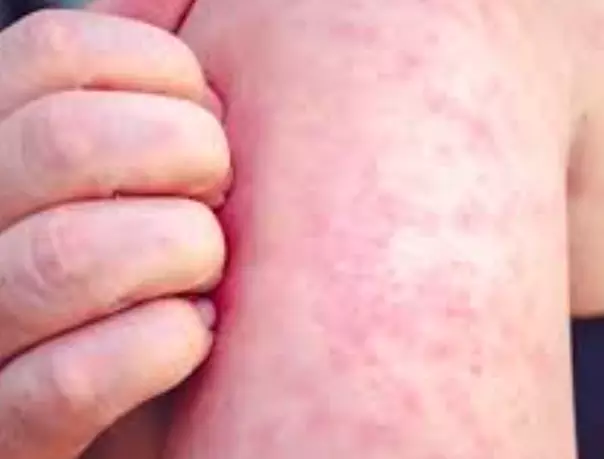 대상포진-초기증상-원인-건강