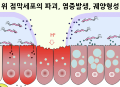 헬리코박터균 10