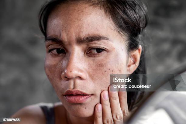 검버섯 관련 사진