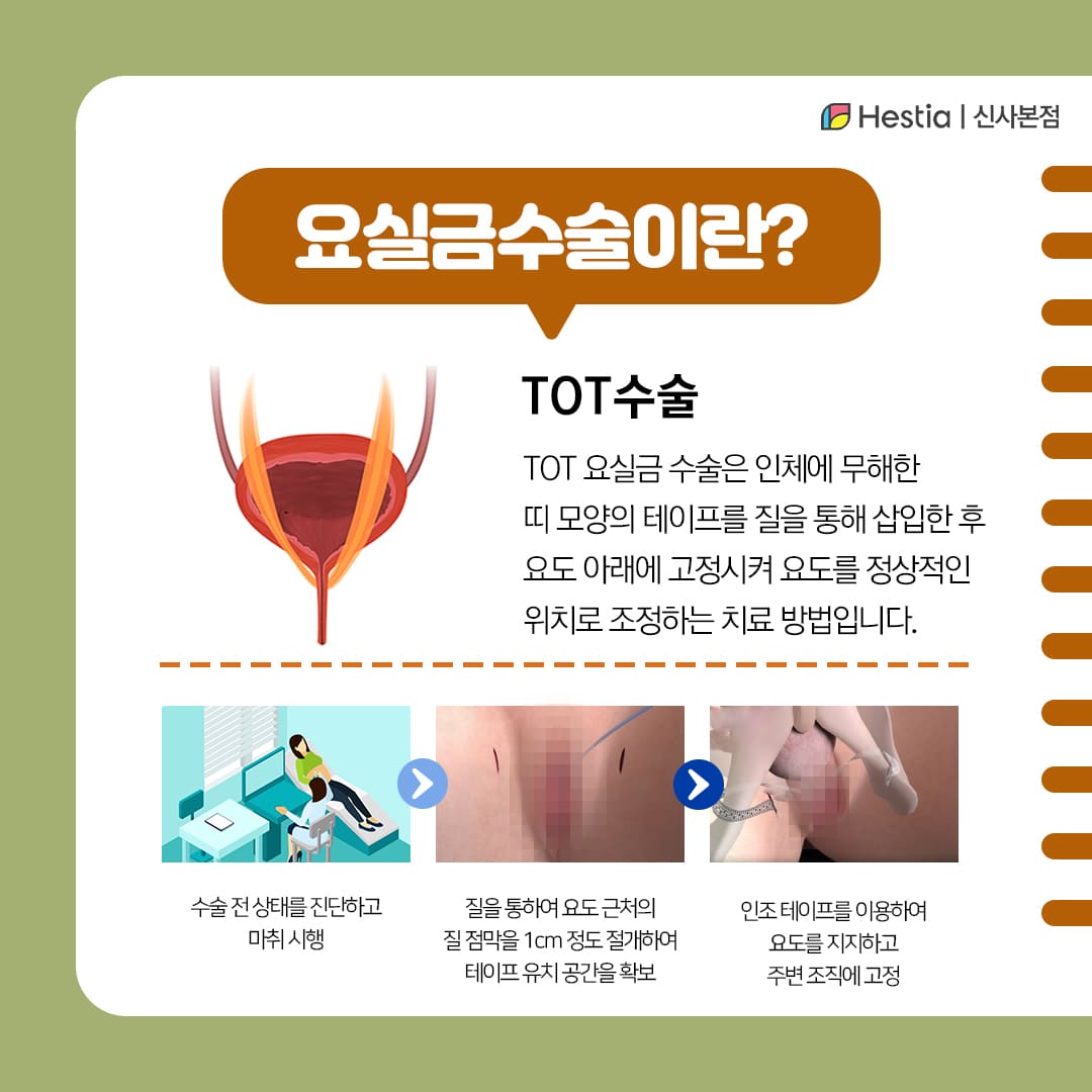 요실금 TOT수술이란?