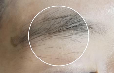 서울 눈썹문신 제거후 관리 제거비용 눈썹문신 제거 후기