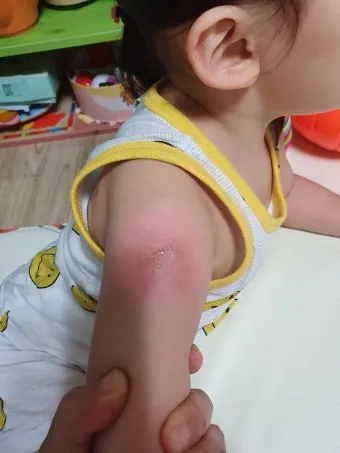 모기 물려 가려울 때 땀띠에 안티푸라민 연고 효능 부작용 사용후기_16