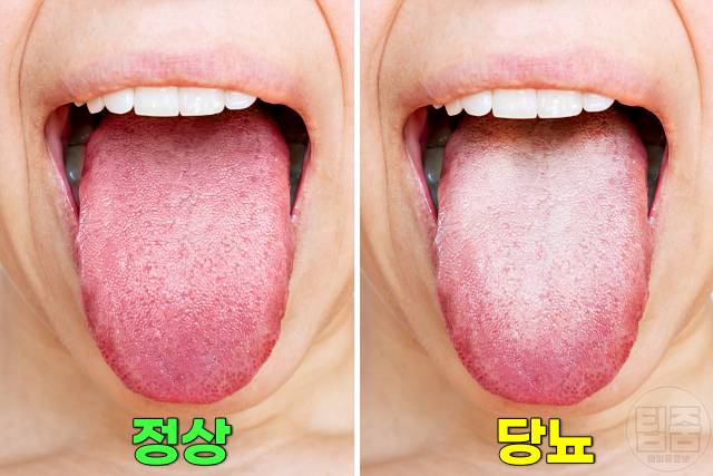 혀백태 원인 제거 혀 백태 안없어짐 당뇨