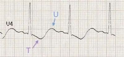저칼륨혈증의 ECG