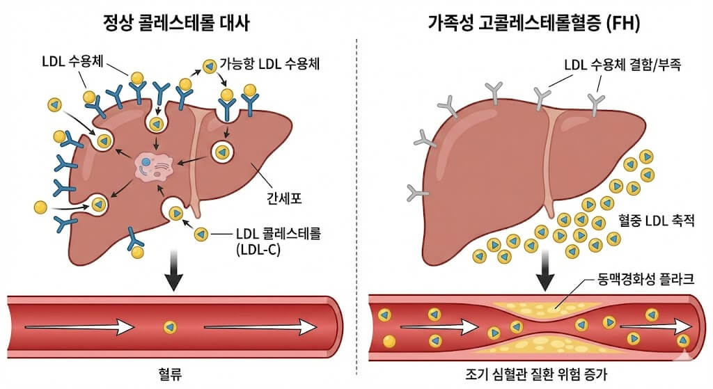 가족성 고콜레스테롤혈증