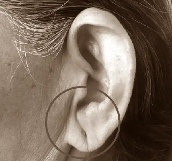 뇌졸중-전조증상-귓볼-주름-귀