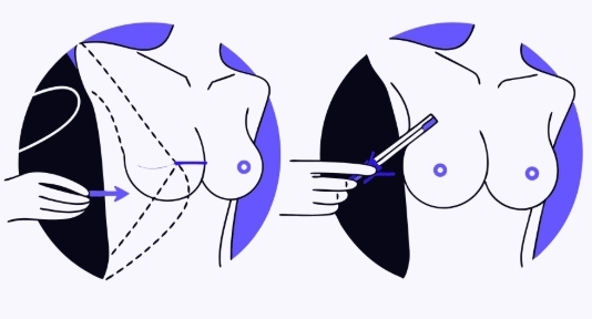 유방암 치료 과정