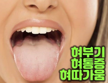 구강 작열감 증후군