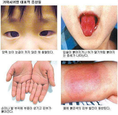가와사키병 증상