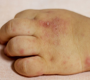 수족구 증상 5가지 | 수족구 잠복기 초기 수포 전염성