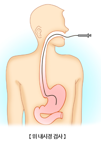 위내시경