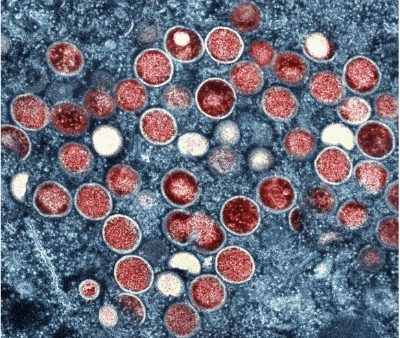 엠폭스 증상 사진 입니다.