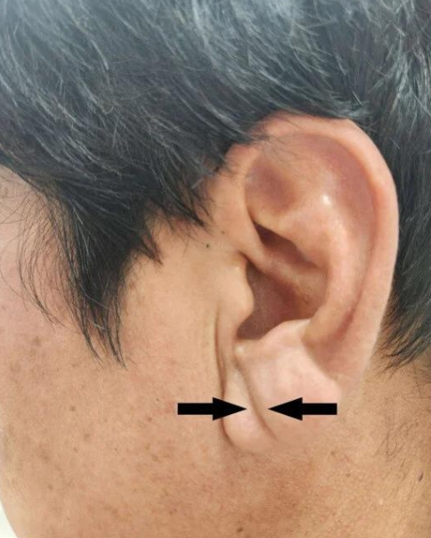 심혈관-뇌경색-질환-귓불-프랭크징후-특징-근거-연령-사진-