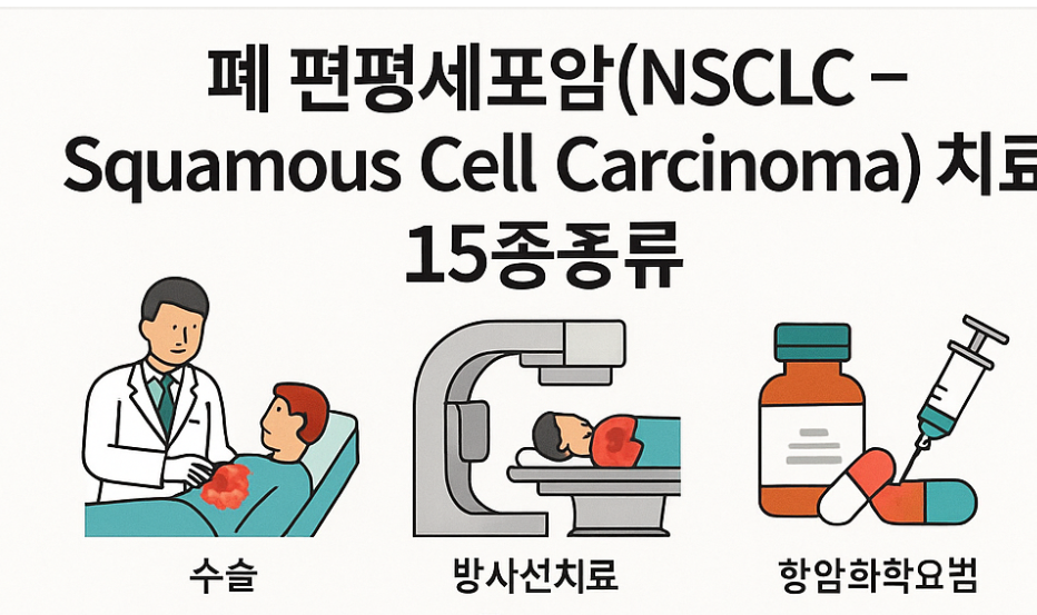 폐 편평세포암 치료 핵심 15가지