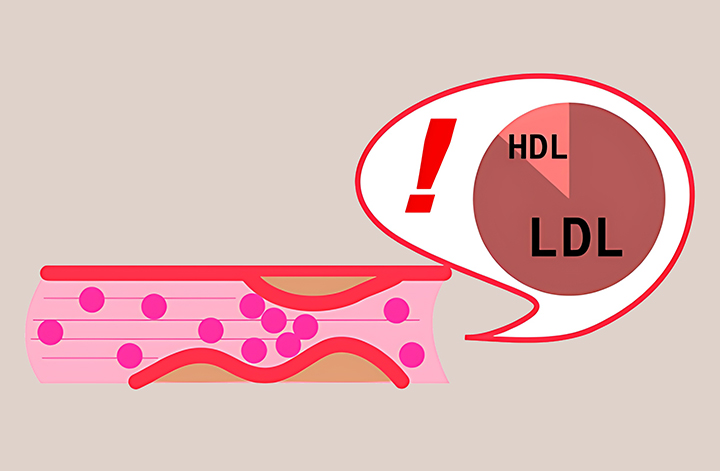 고지혈증의-혈관-모습
