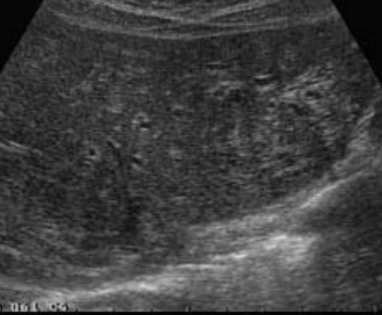 담관염(Cholangitis)